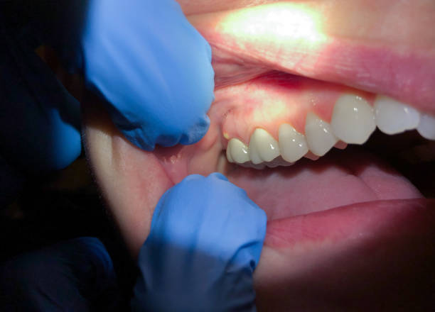 Best Emergency Wisdom Teeth Removal in Washington, WV